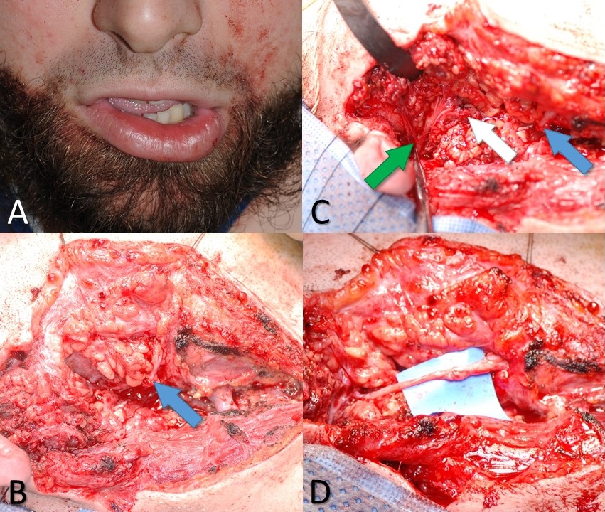 A 26-year-old male with a knife wound to the right neck