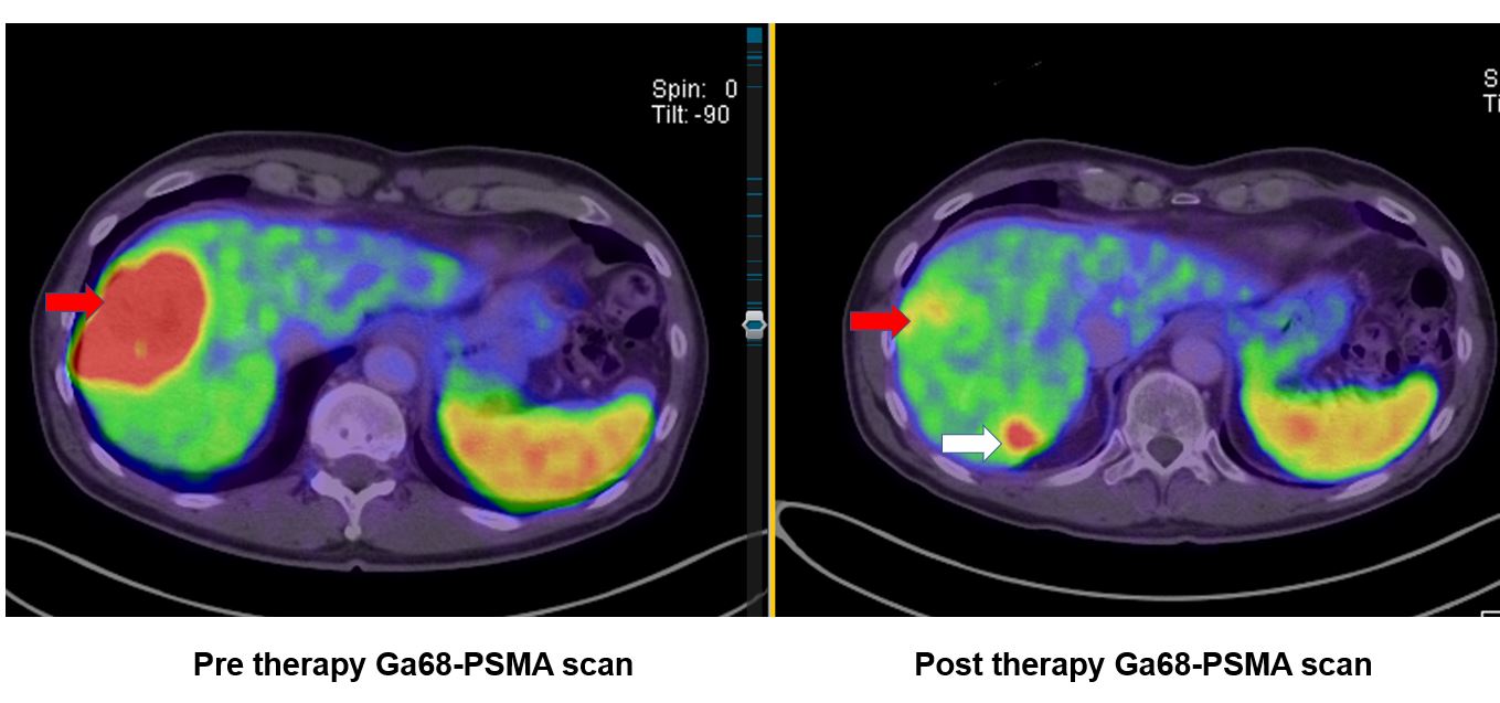 Positive treatment outcome in a hepatic metastatic lesion post 4 cycles of 177-Lu-PSMA treatment