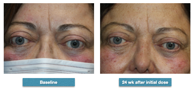 Patient before-and-after completing the series of 8 infusions of teprotumumab