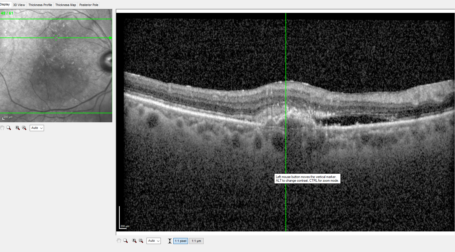 <p>Retinal Pigment Epithelial Detachment