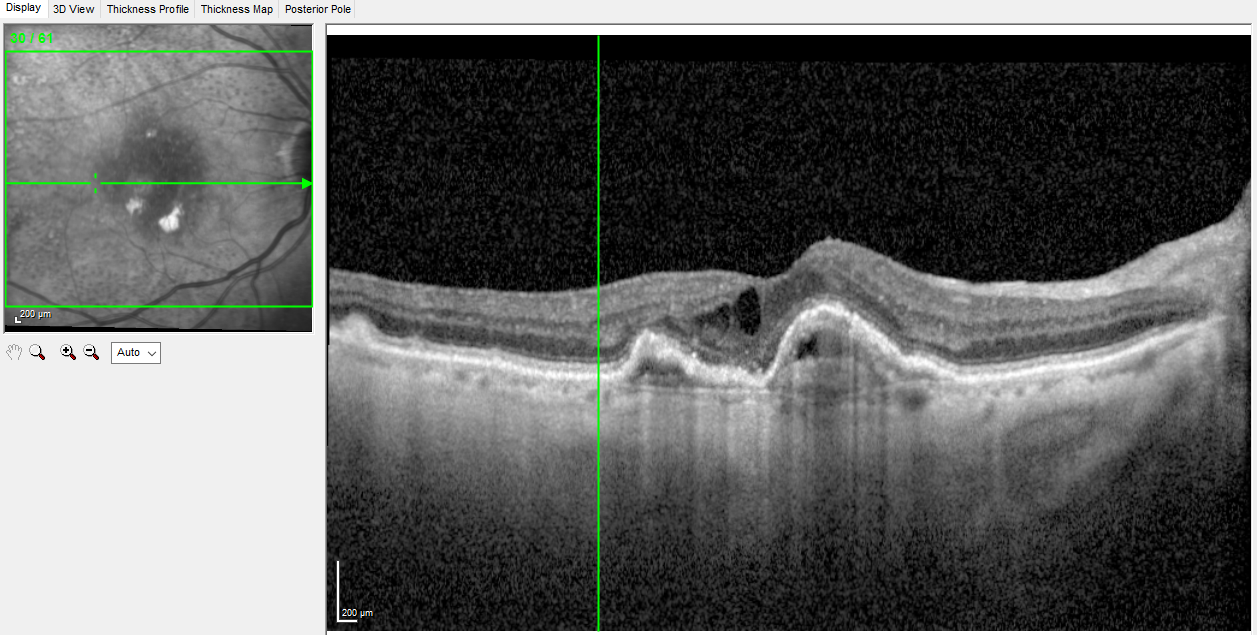 <p>Fibrovascular Retinal Pigment Epithelial Detachment