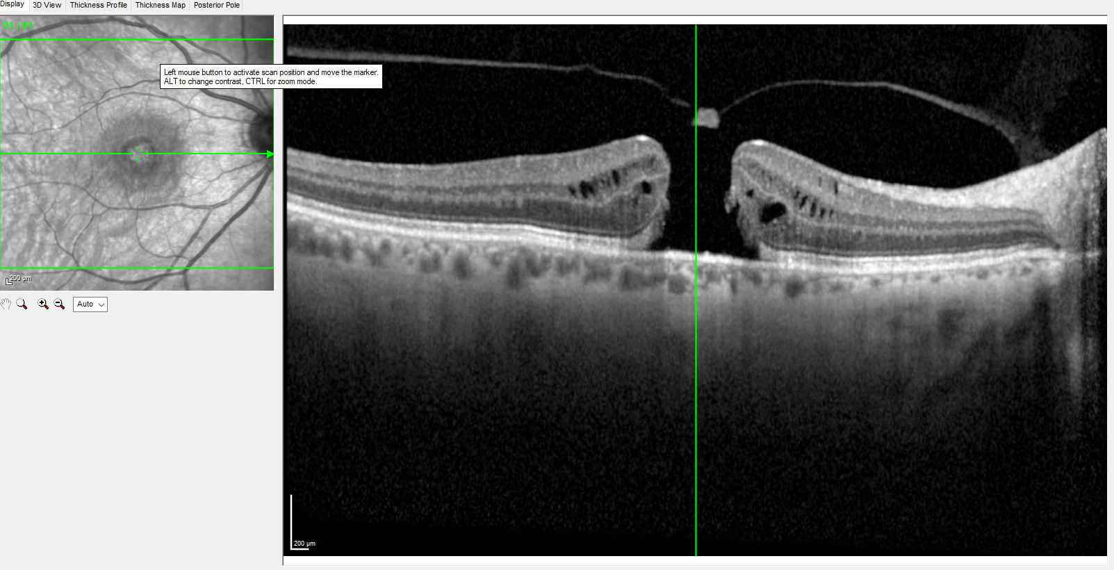 <p>Optical Coherence Tomography, Full-Thickness Macular Hole