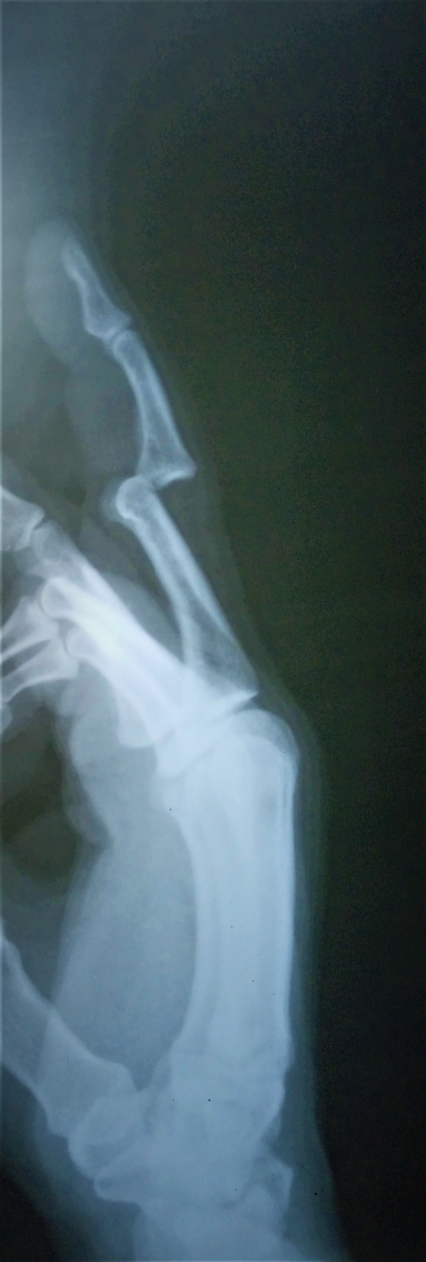 PIP Joint Dorsal Dislocation
