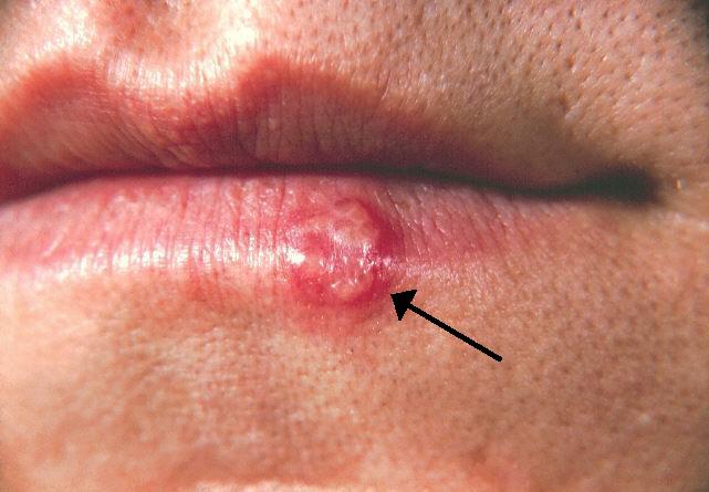 <p>Herpes Labialis.</p>