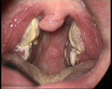 <p>Infectious Mononucleosis.</p>