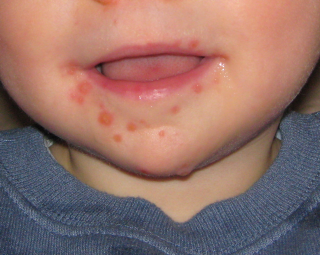 <p>Hand, Foot, and Mouth Virus, Lesions.</p>