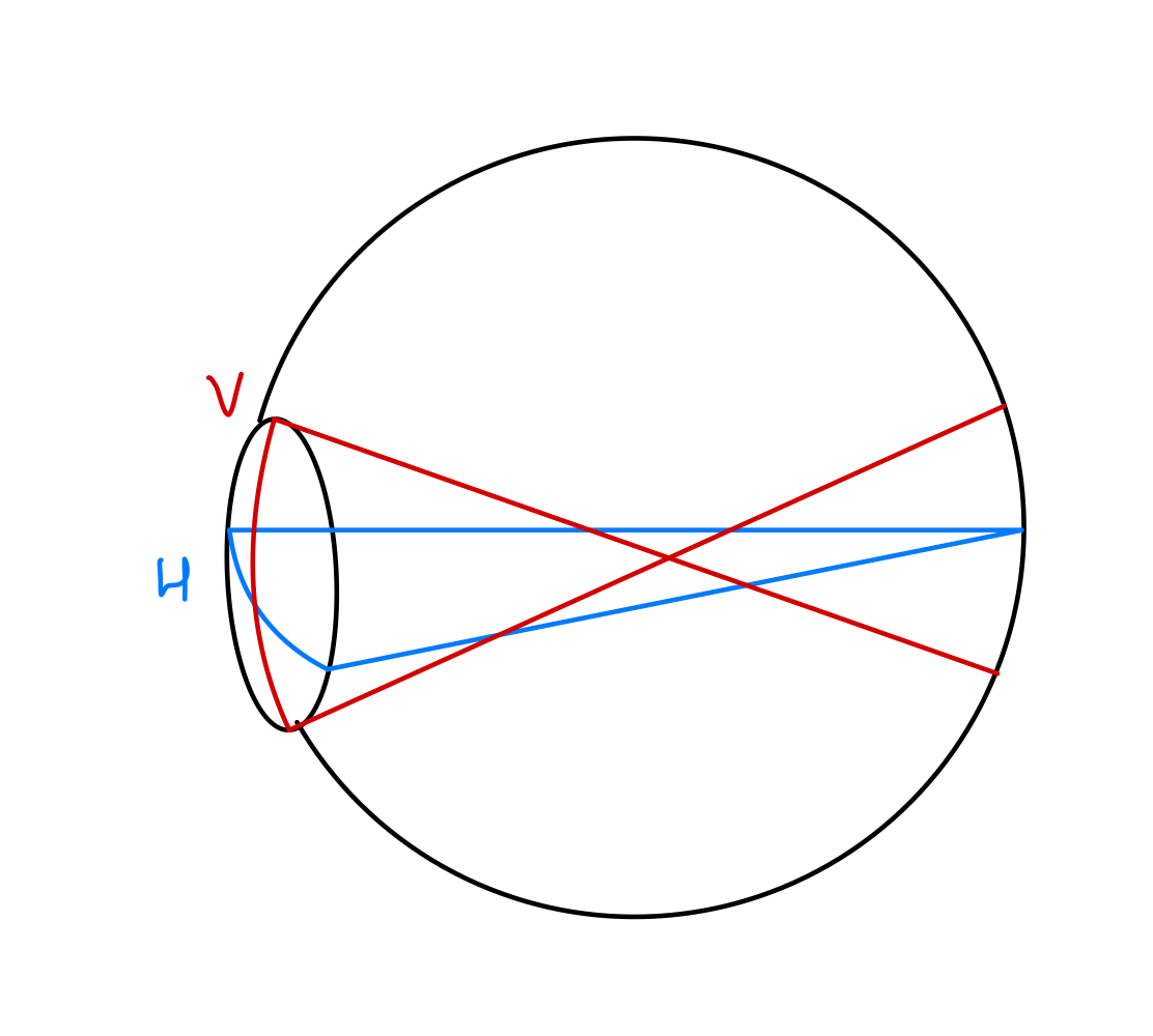 <p>Simple Myopic Astigmatism.</p>