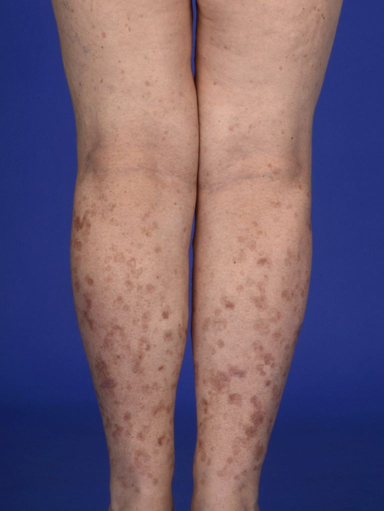 <p>Disseminated Superficial Actinic Porokeratosis (DSAP)</p>