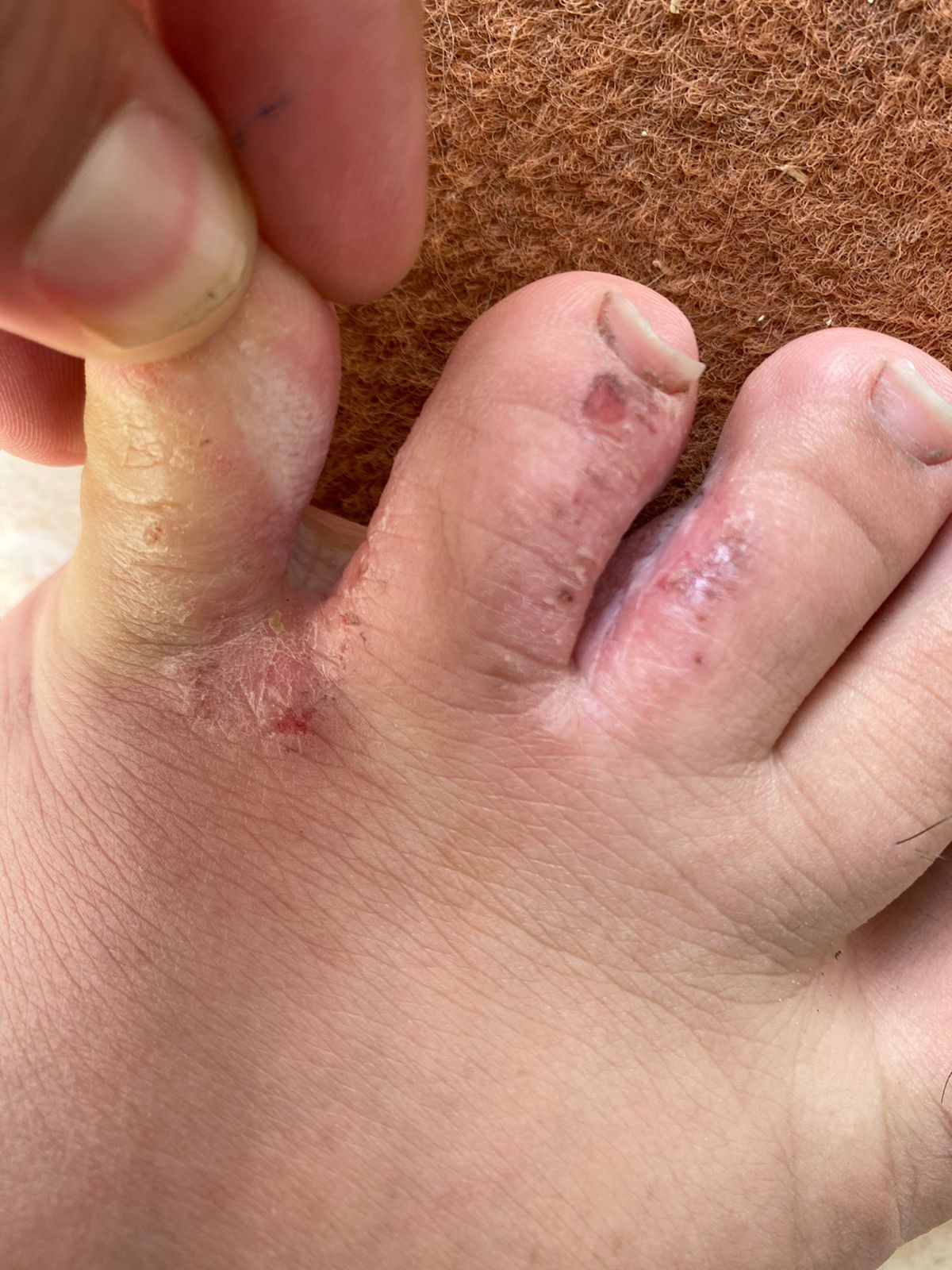 Tinea pedis seen in a female patient