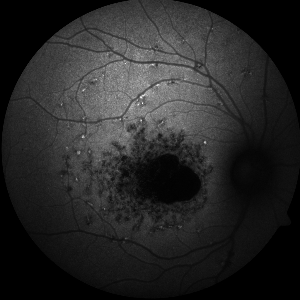 <p>Short-Wavelength Fundus Autofluorescence