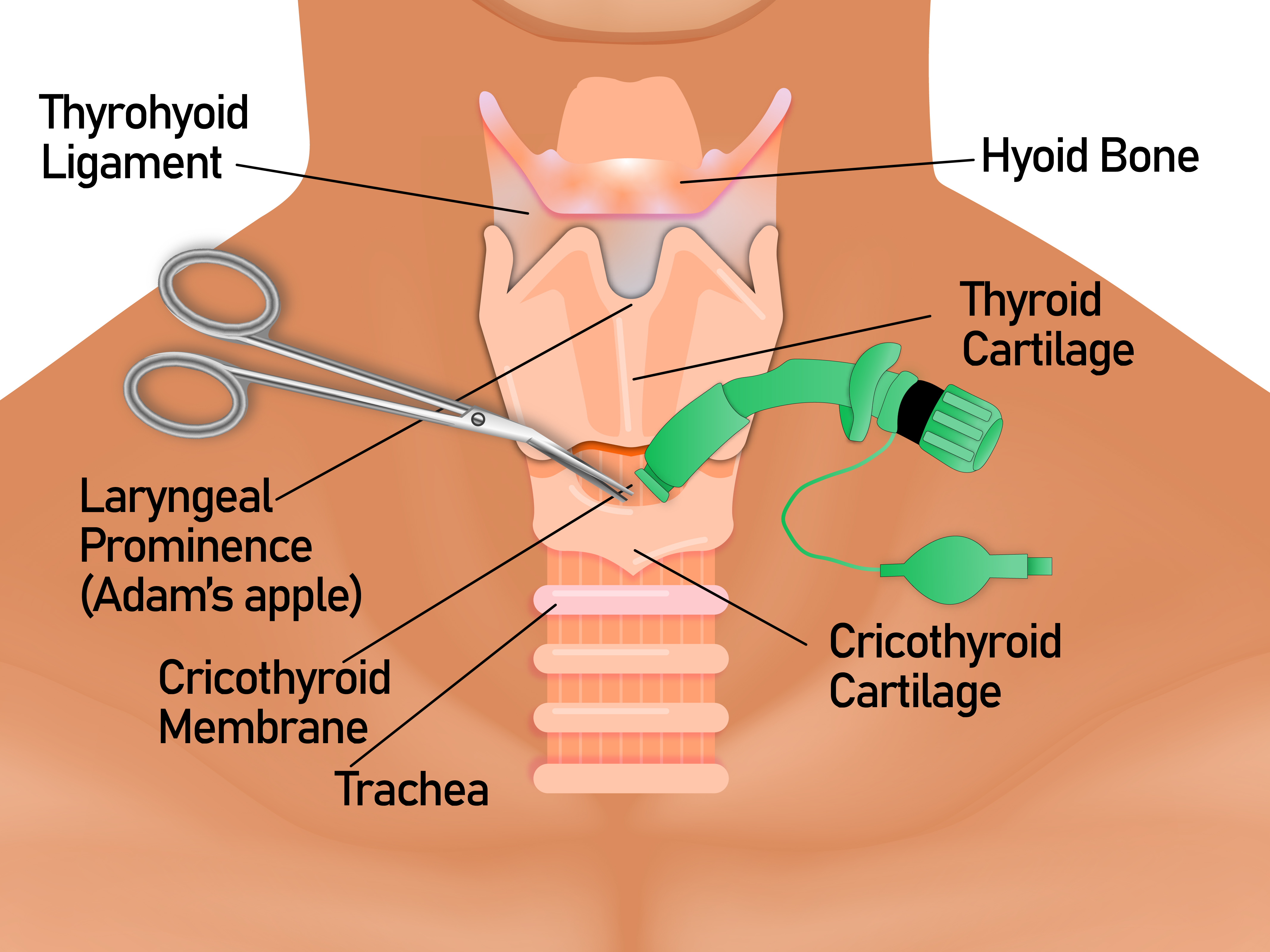 <p>Anatomy and Airway Framework of the Neck