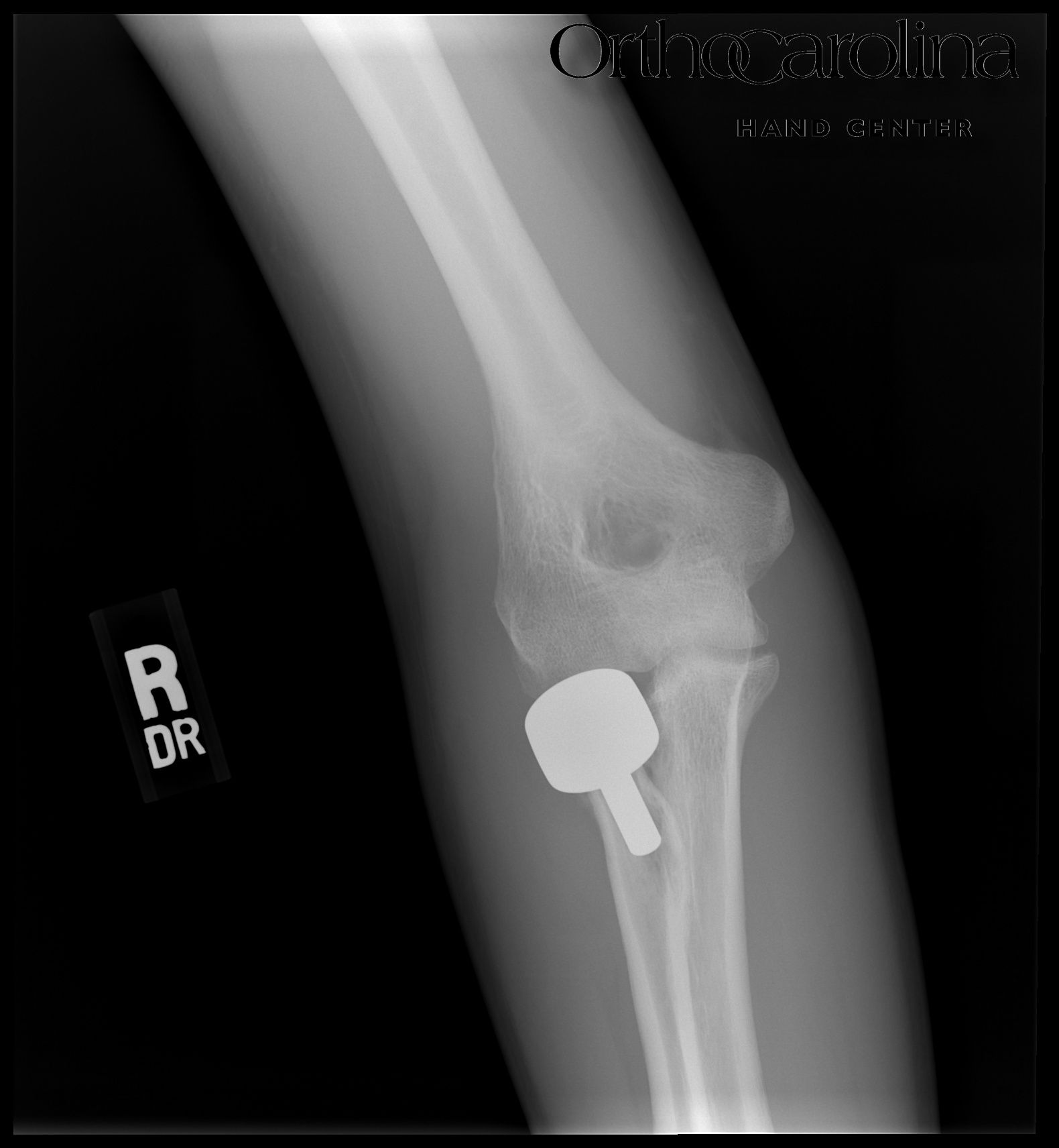 Figure 2. Postoperative radial head arthroplasty with radial head implant