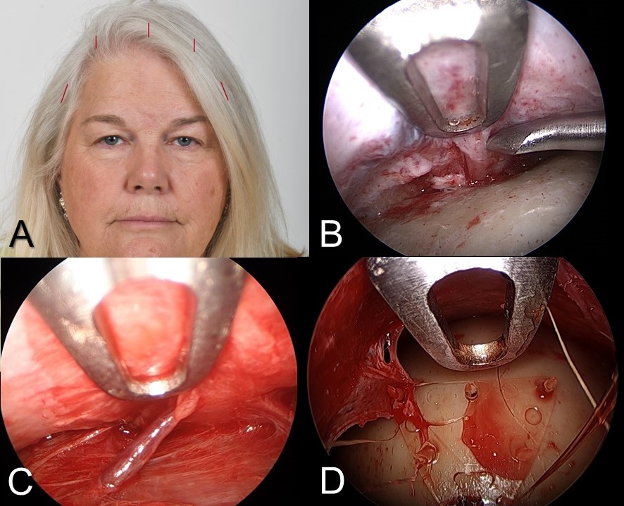 <p>Endoscopic Brow Lift