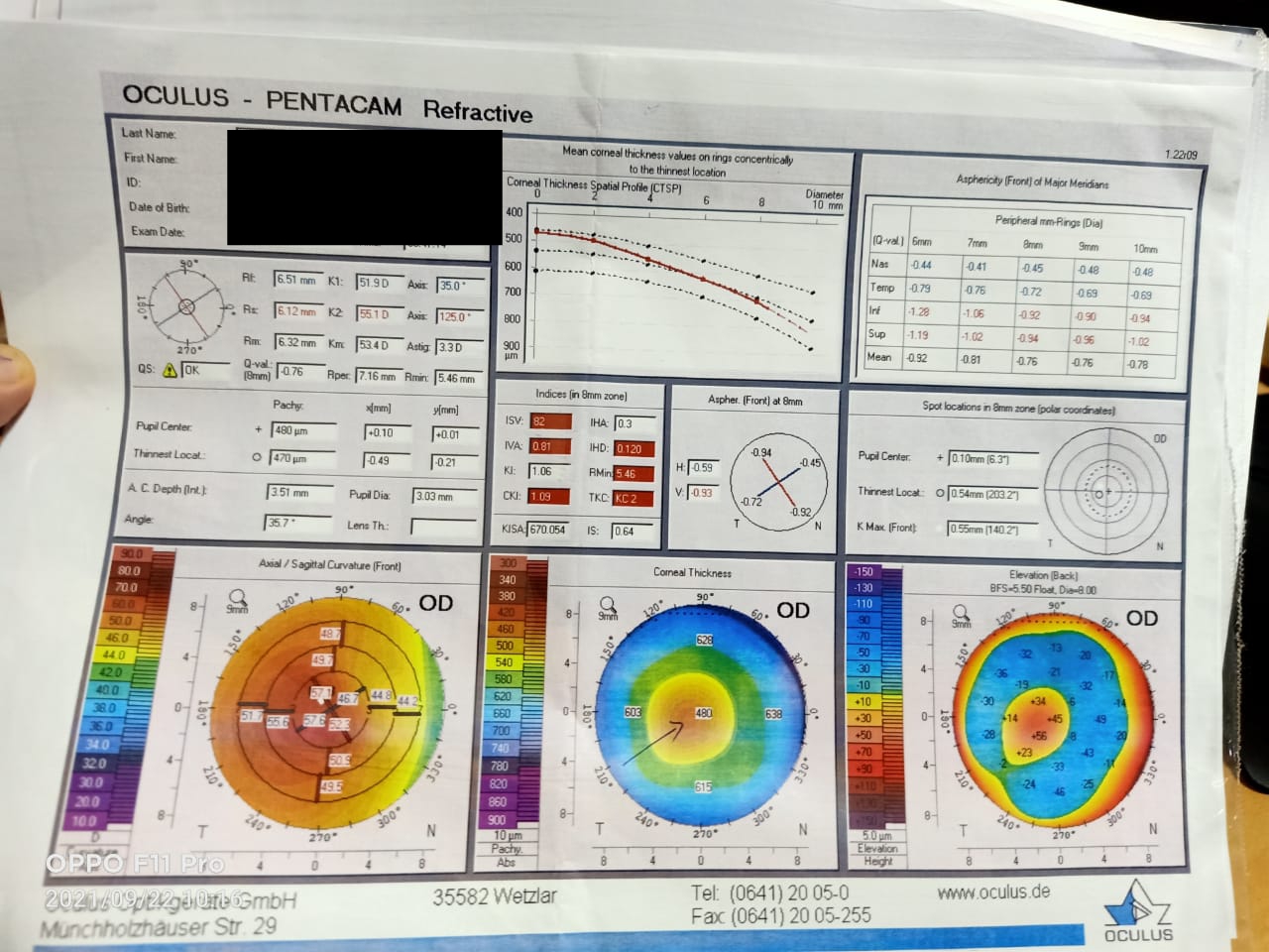 Digital Schiempflug image of the patient depicting severe keratoconus requiring corneal collagen cross linking with riboflavi