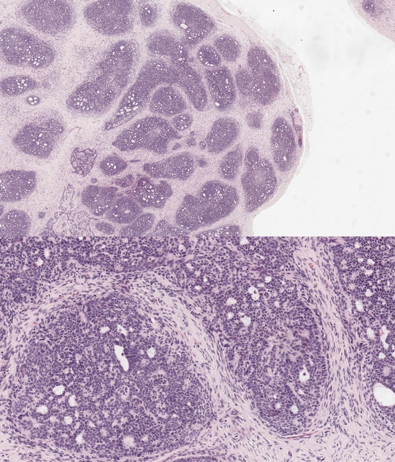 <p>Trichoblastoma</p>