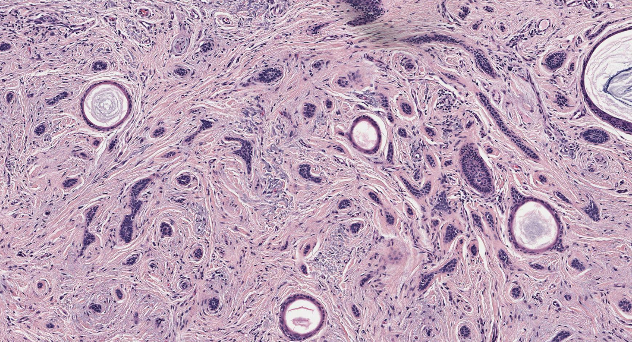 <p>Desmoplastic Trichoepithelioma</p>