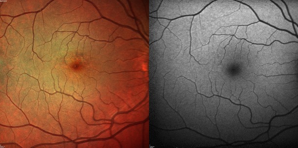 Mild pentosan polysulfate maculopathy of the right eye as imaged with false color and fundus autofluorescence