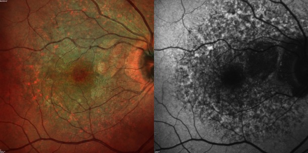 Moderate pentosan polysulfate maculopathy of the right eye as imaged with false color and fundus autofluorescence