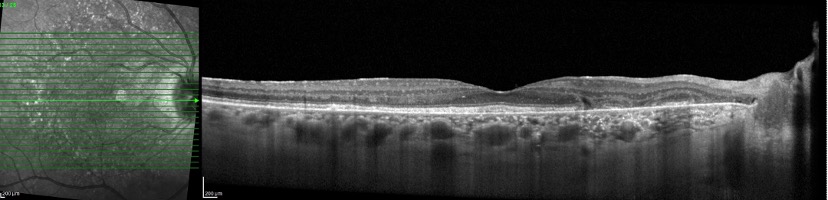 Moderate pentosan polysulfate maculopathy of the right eye as imaged with optical coherence tomography