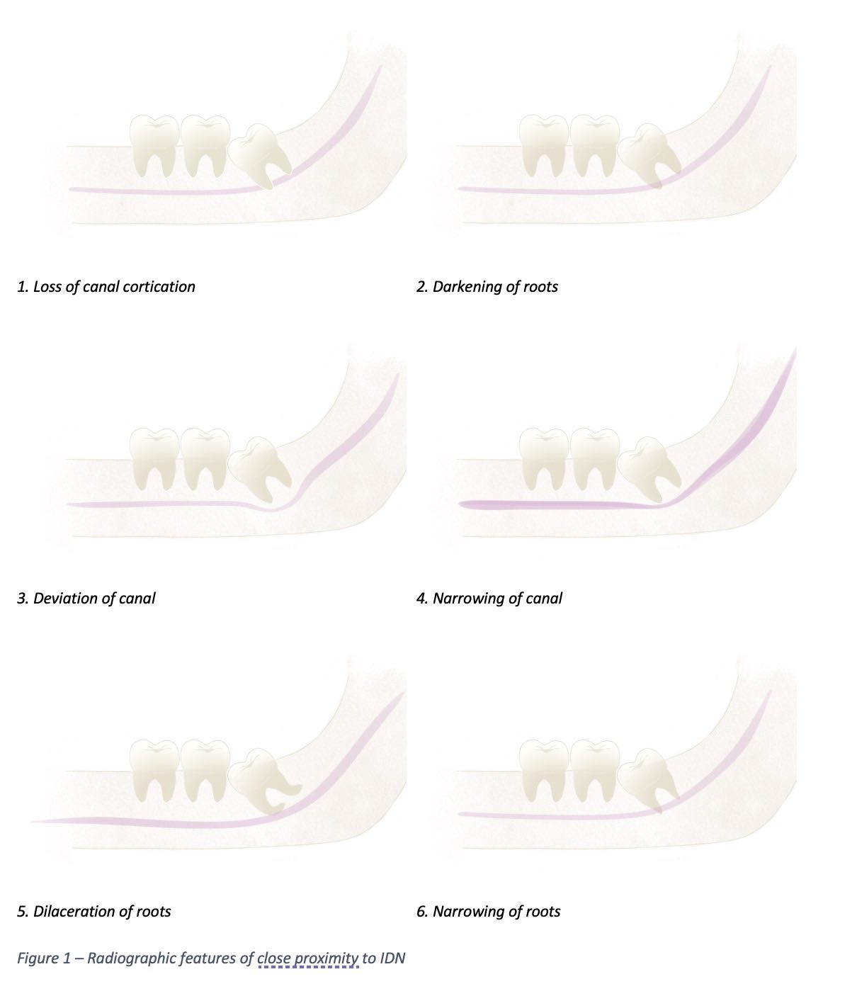 <p>Radiographic features suggestive of close proximity to IDC.</p>