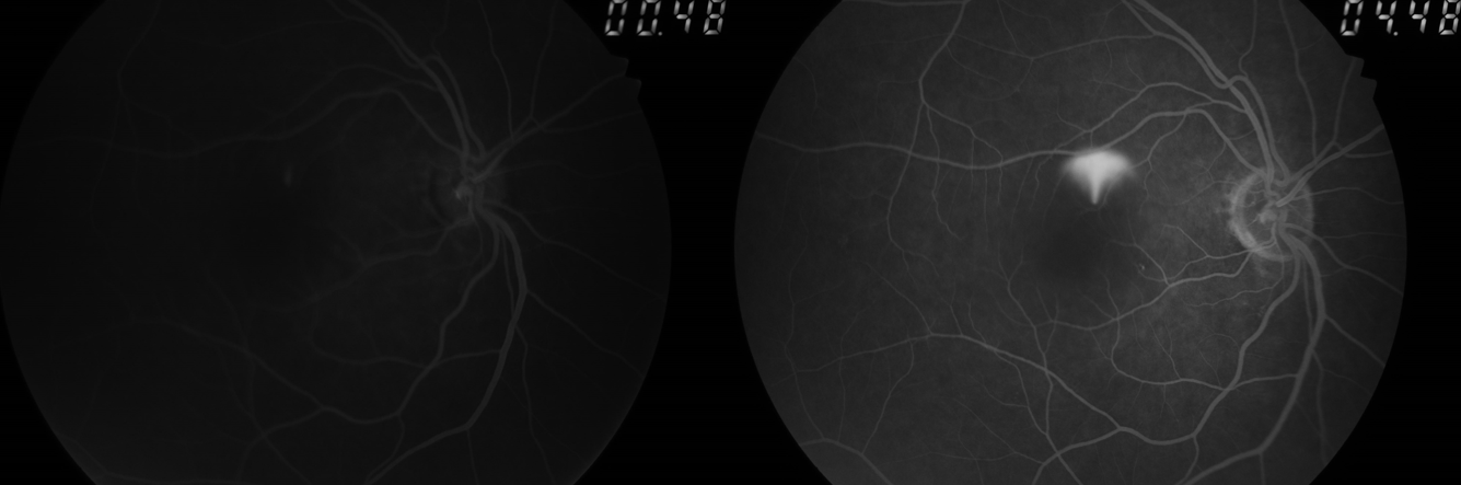 Smoke-stack leak in central serous chorioretinopathy (CSCR pr CSR)