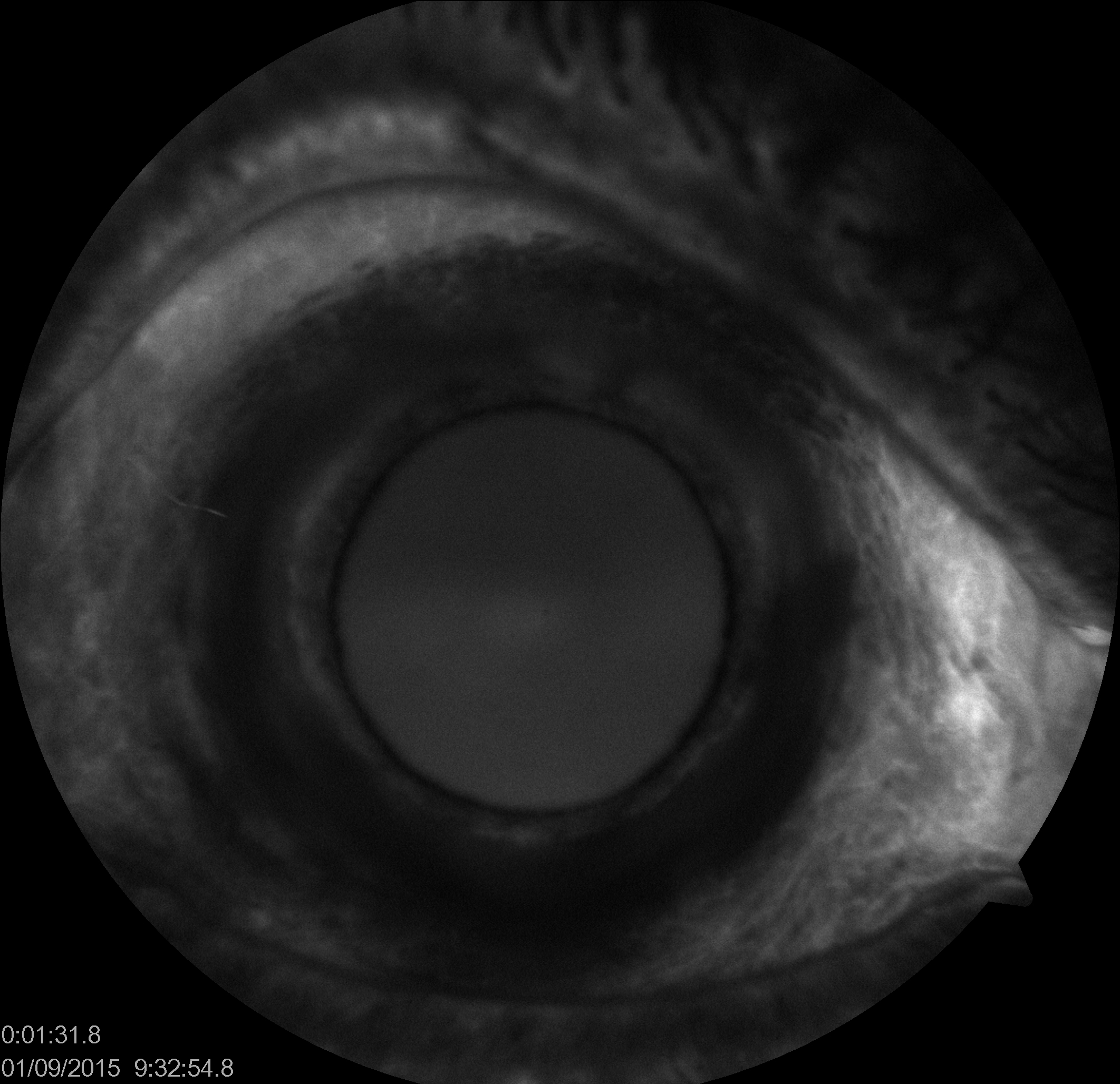 Appearance of new vessels in the iris (NVI) in FFA