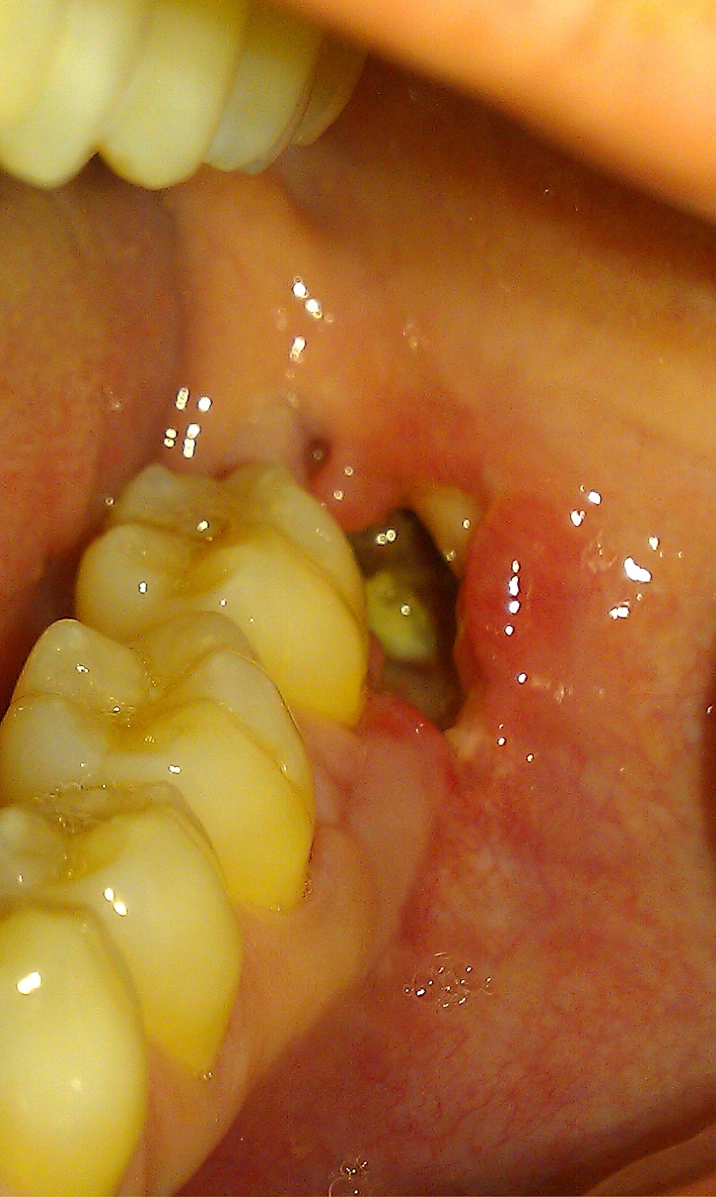 <p>Alveolar Osteitis. Image of alveolar osteitis with alveolar bone exposure in a patient after exodontia.</p>