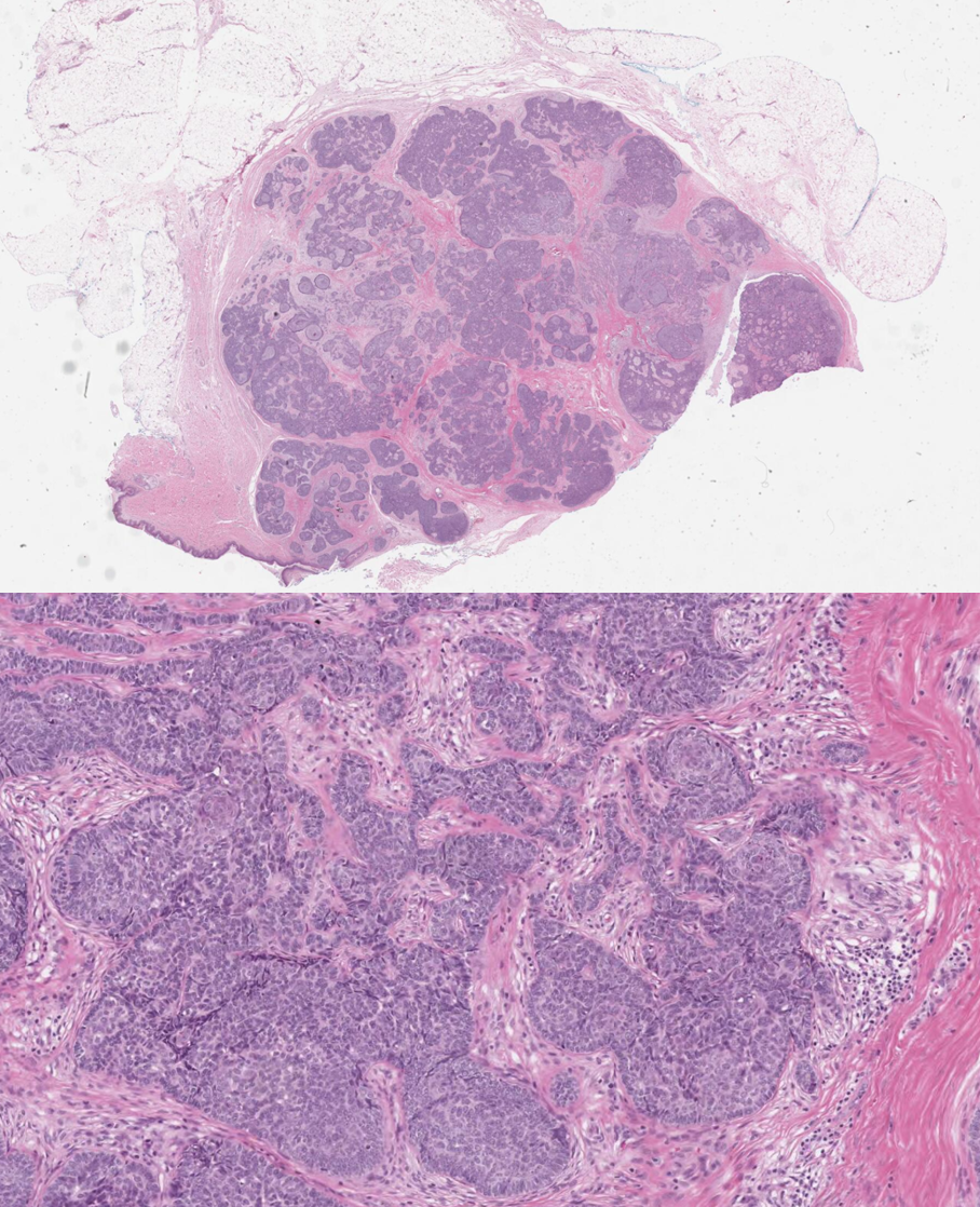 <p>Trichoblastoma Path</p>