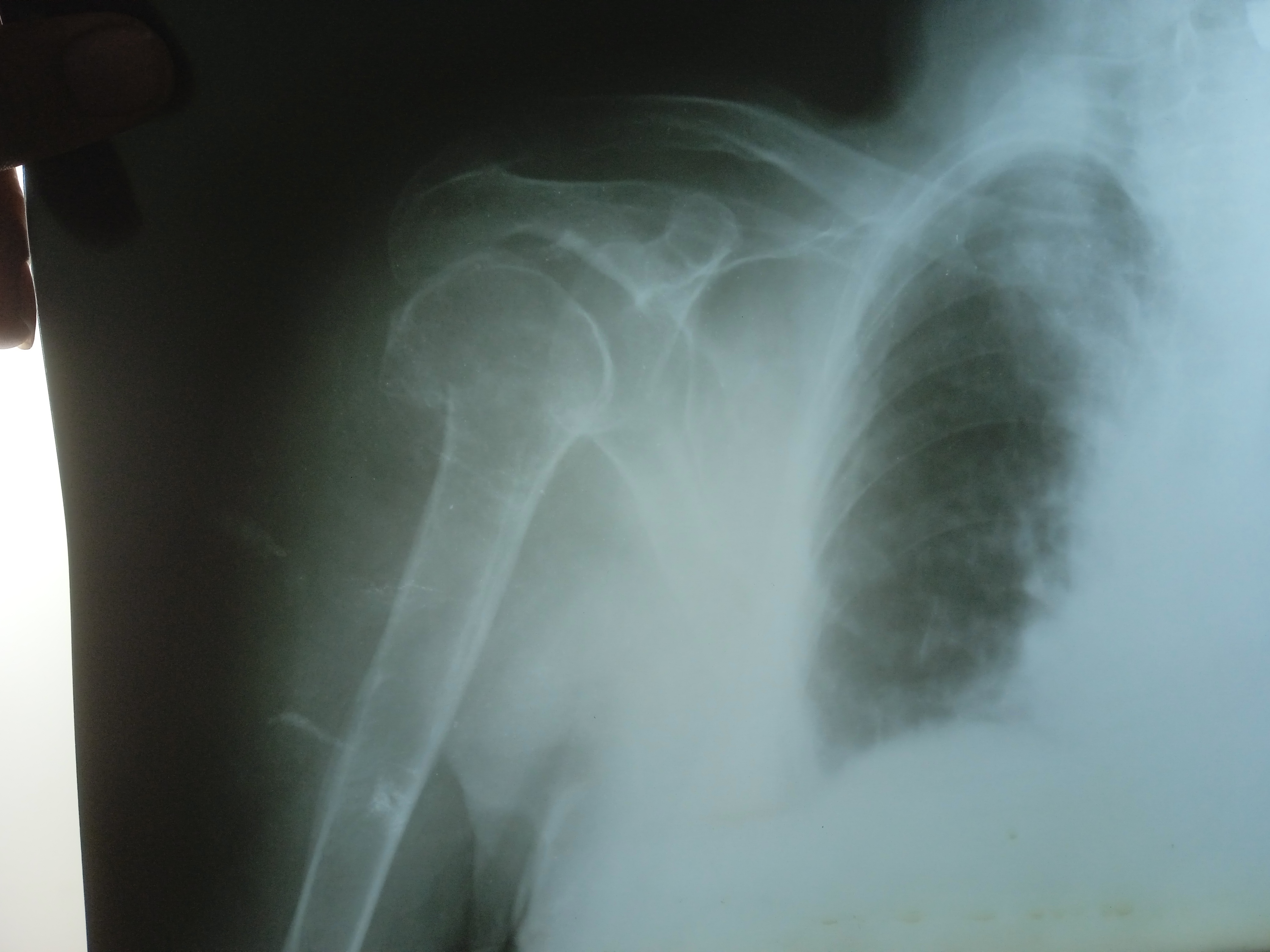 <p>Fracture Of The Proximal Third Of The Humerus. This image shows a fracture of the surgical neck of&nbsp;the humerus.</p>