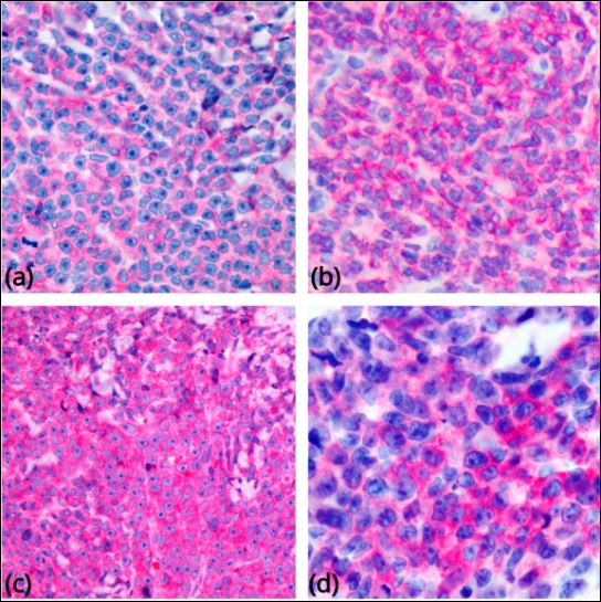 Most common phenotypic findings in BPDCN