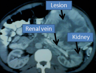 <p>A Giant Pheochromocytoma.</p>