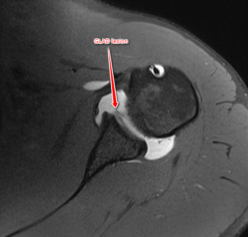 <p>Magnetic Resonance Angiography, Axial GLAD Lesion</p>