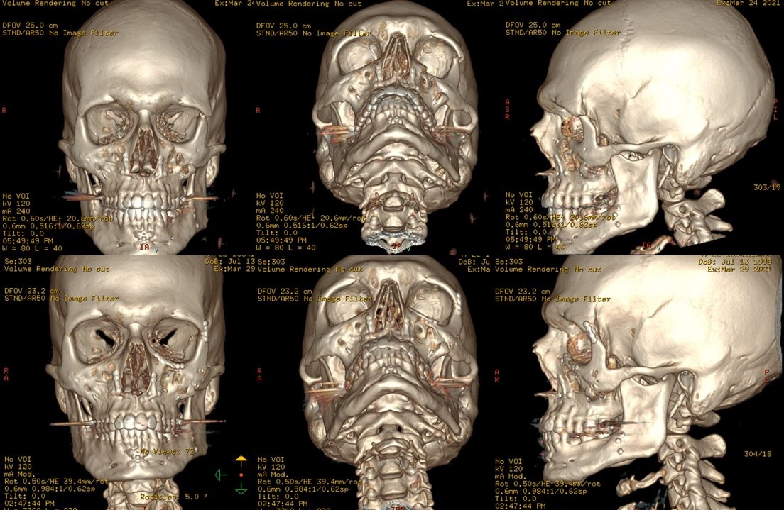 <p>3D Reconstructions of Left ZOMC