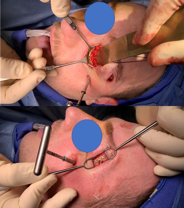 <p>ORIF of ZOMC Fracture