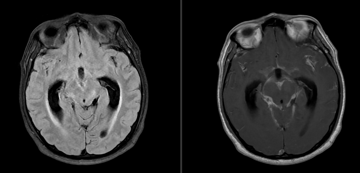 <p>Tuberculous Meningitis on Magnetic Resonance Imaging</p>