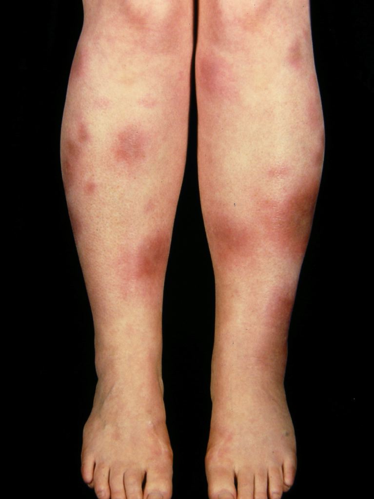 <p>Erythema Nodosum</p>