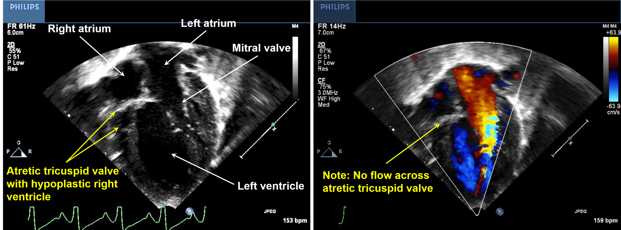 <p>Echocardiography of a Patient With Tricuspid Atresia