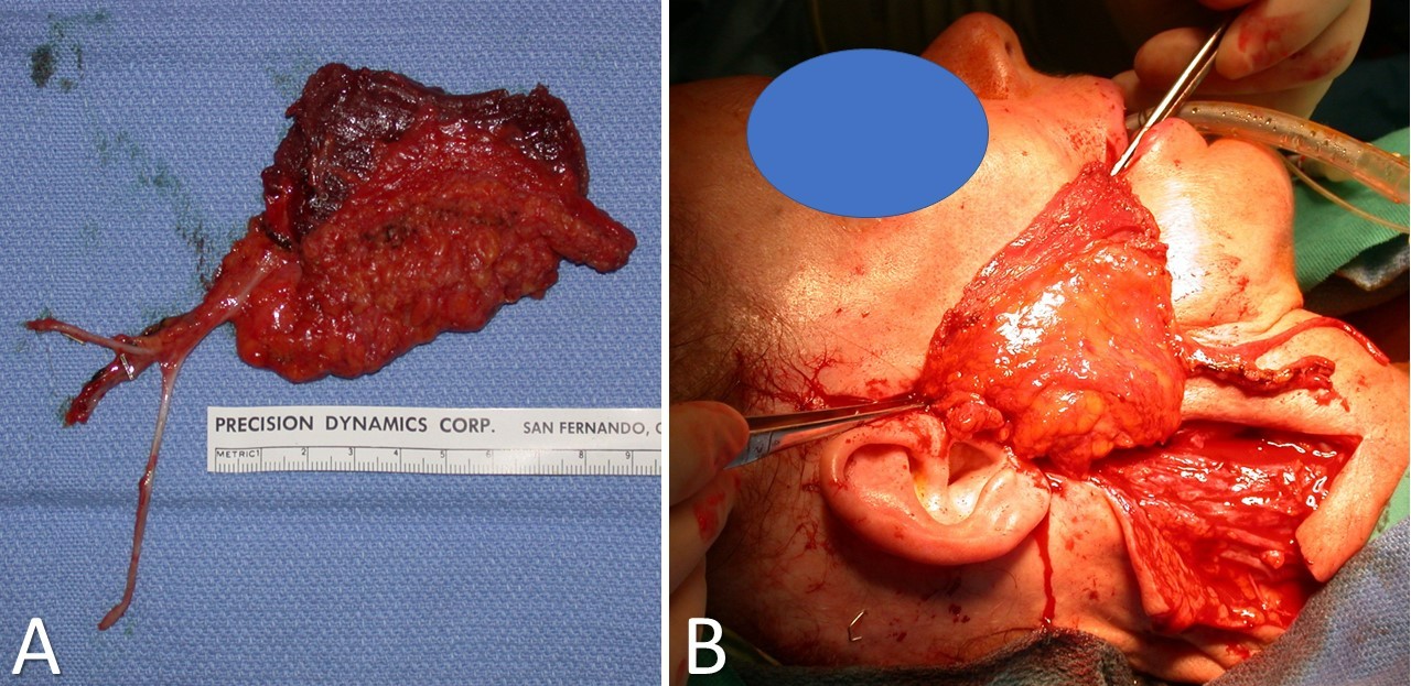 <p>Latissimus Dorsi Myofascial Free Flap