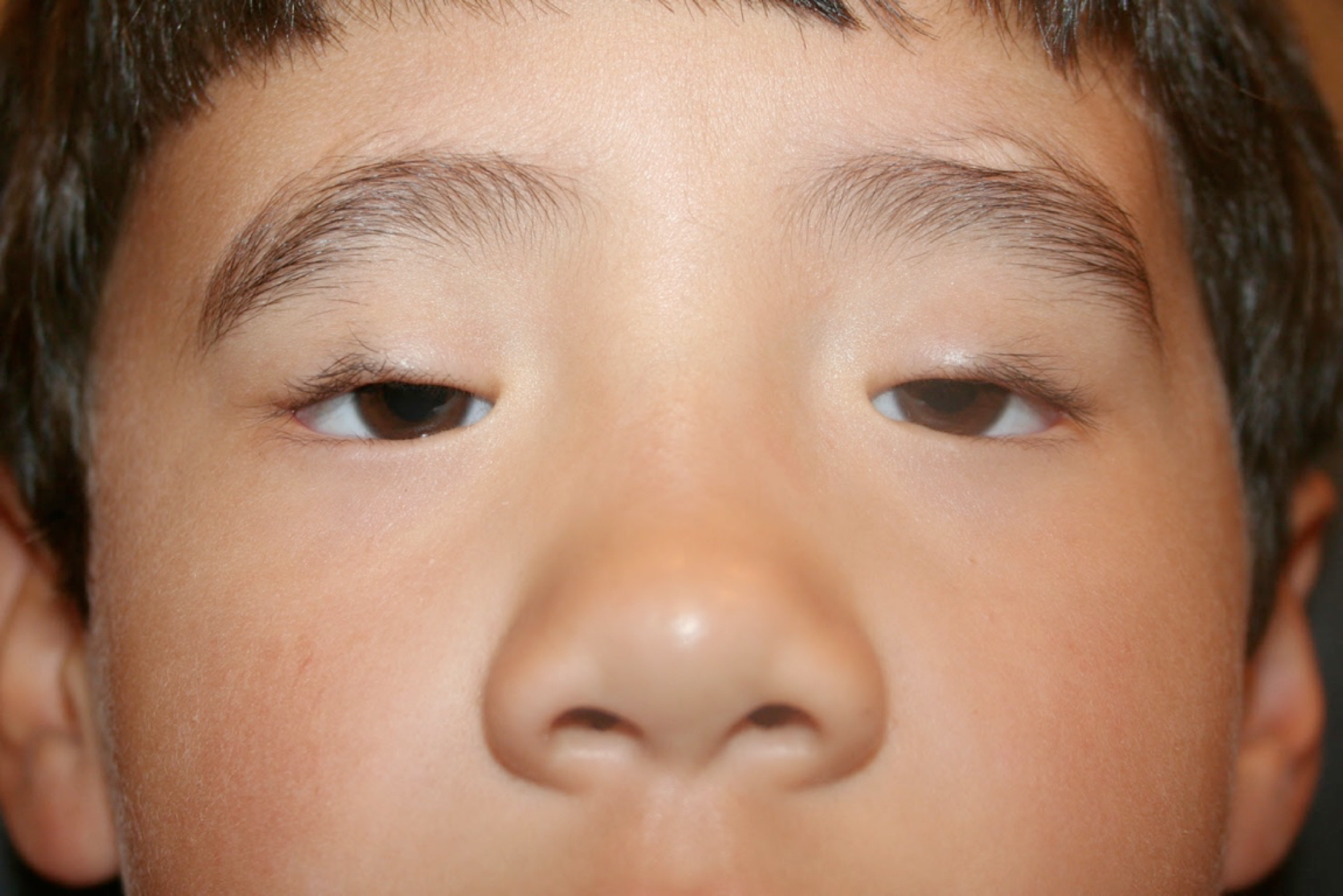 <p>Male Child with Blepharophimosis Syndrome