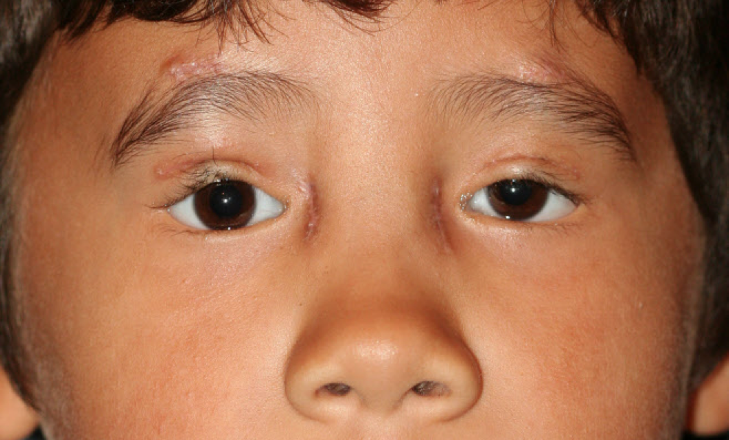 <p>Male Child After Surgery for Blepharophimosis Syndrome