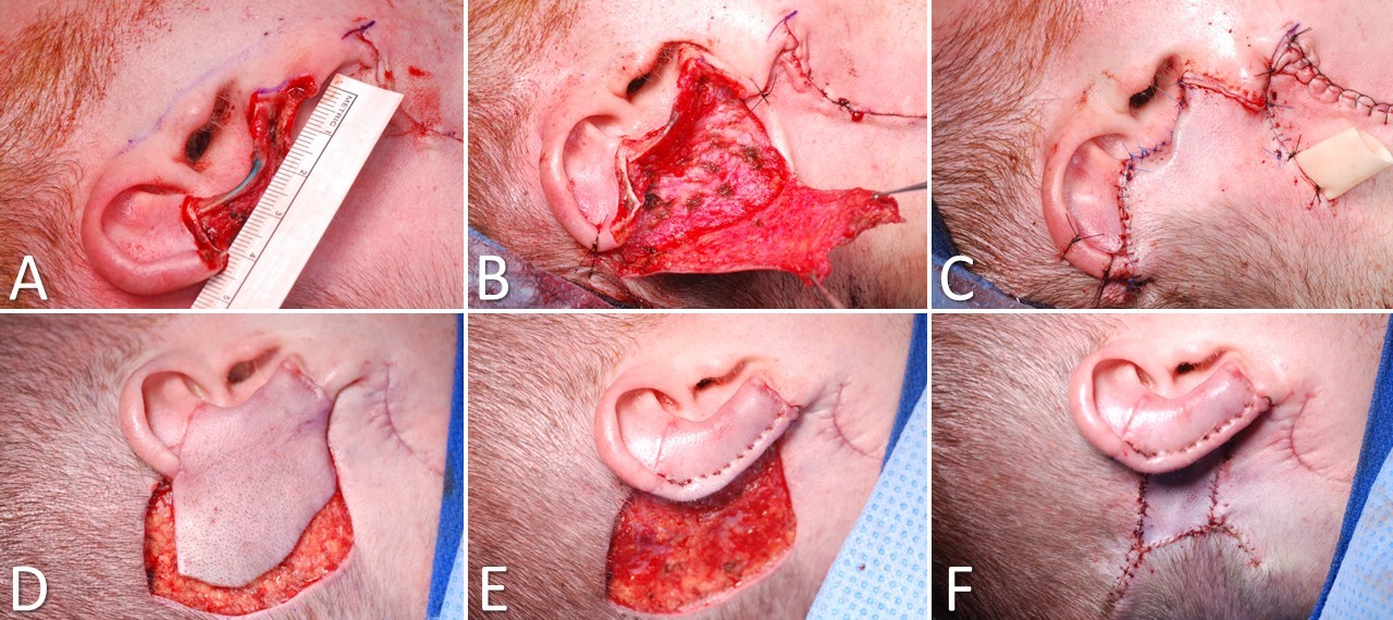 <p>Postauricular Flap for Auricular Reconstruction