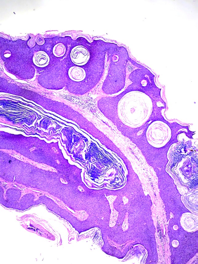 <p>Seborrheic Keratosis Histopathology 1