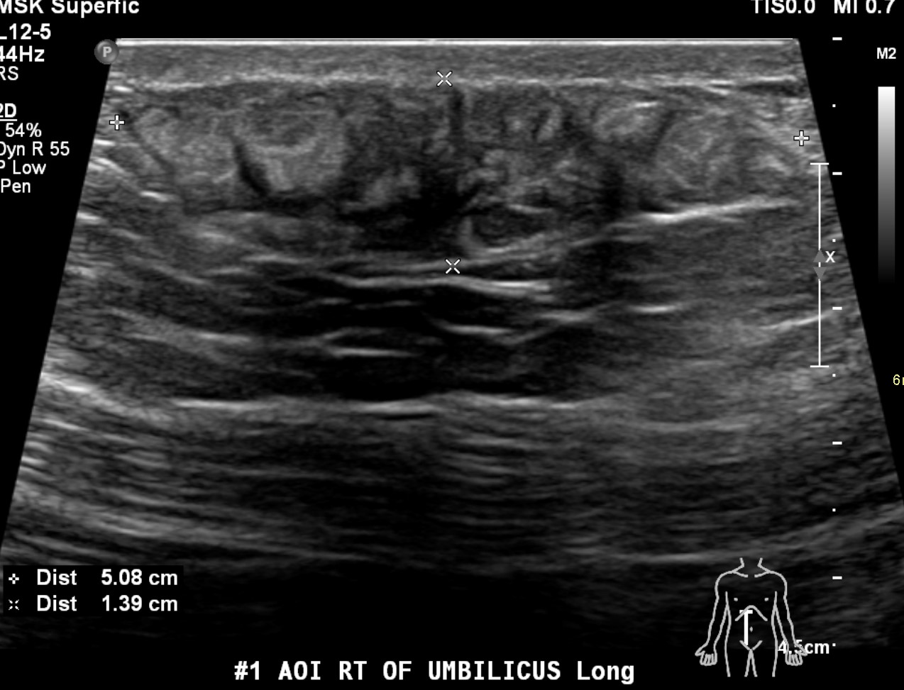 Patient 1: A 59-year-old male with type-2 insulin-dependent diabetes mellitus, chronic kidney disease, and suspected amyloidosis presents for a 4-year follow-up of painful, enlarging ventral abdominal masses corresponding to his insulin injection sites