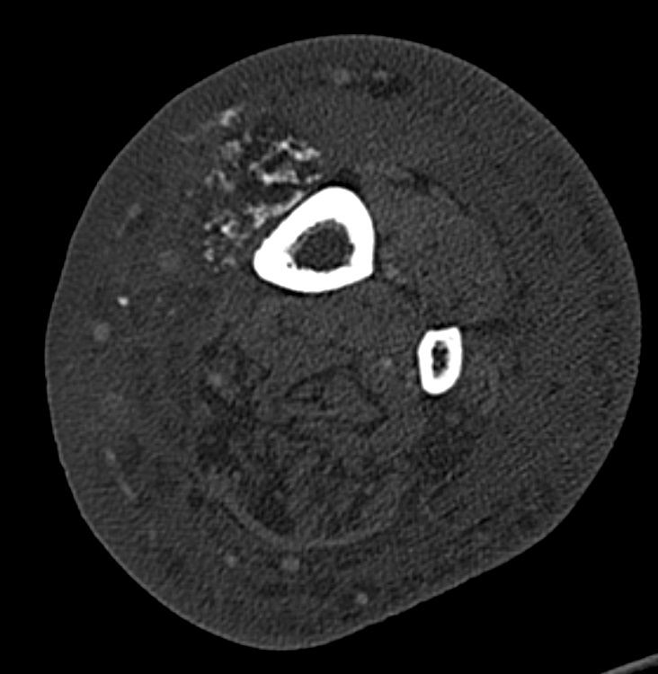 Patient 2: A 70-year-old male with pathology-proven Amyloid Light Chain (AL) amyloidosis, now in remission following chemotherapeutic intervention two years prior, presents for follow-up of enlarging and painful lower extremity nodules