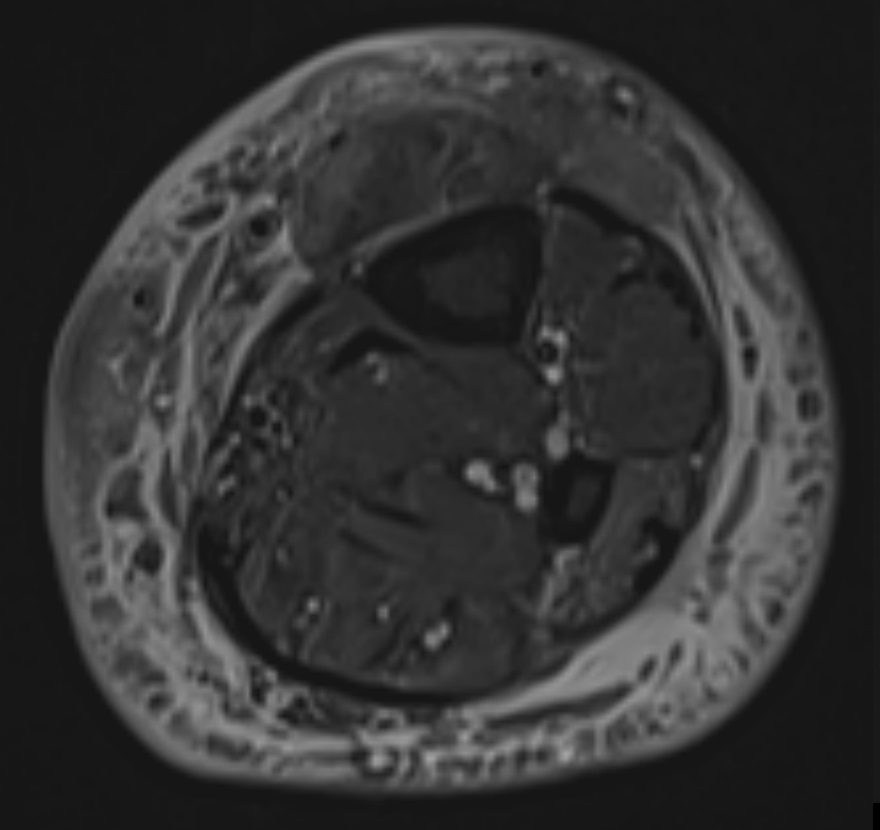 Patient 2: A 68-year-old male presents with an enlarging and painful left lower extremity nodule overlying the tibia