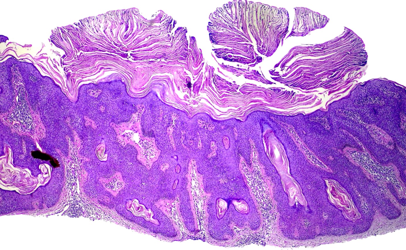 <p>Seborrheic Keratosis Histopathology 2