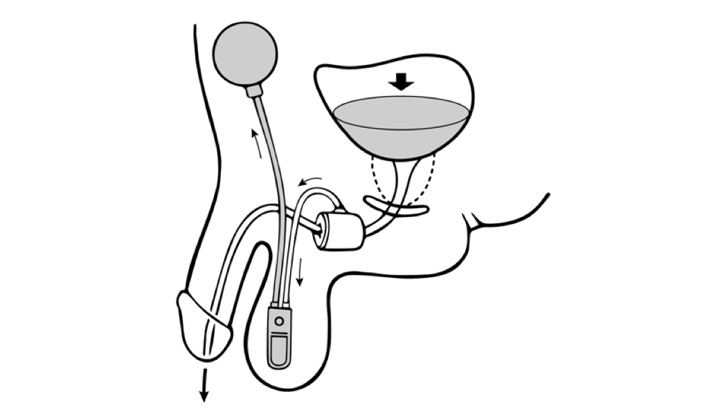 Opening of cuff by manipulation of cuff, allowing for urination