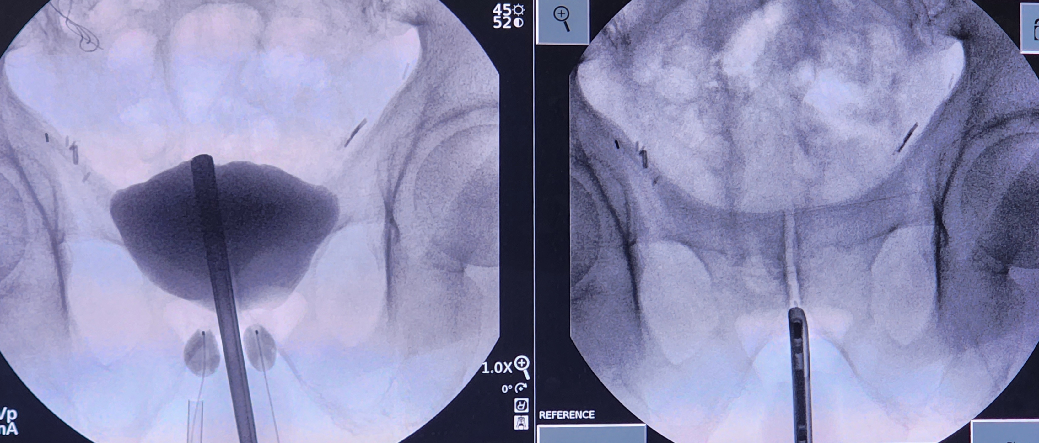 Left: Appropriate placement of dual-balloon adjustable continence therapy
Right: Anatomic reference of cystoscope at the bla