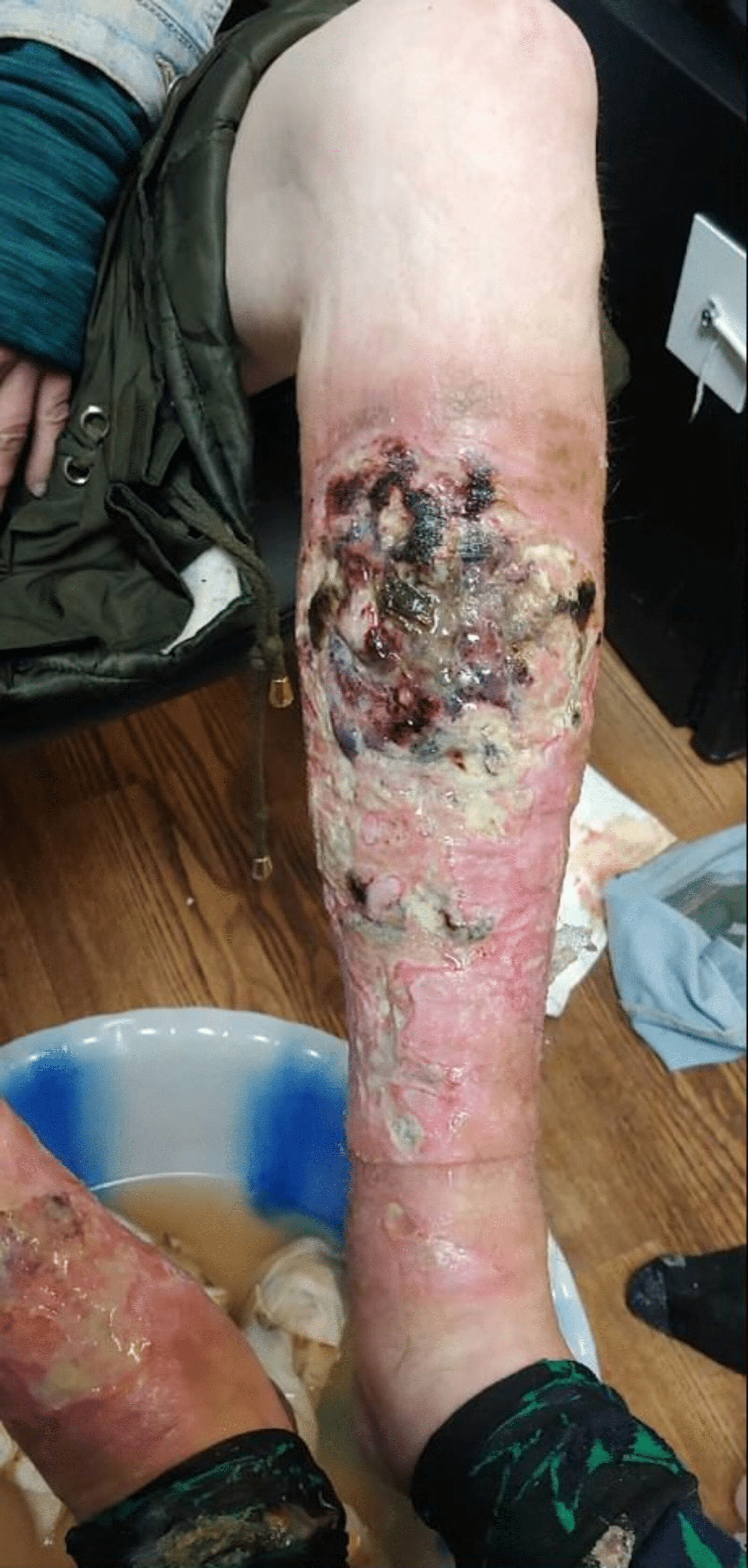 Xylazine-induced Leg Skin Ulcers, Cellulitis and Osteomyelitis