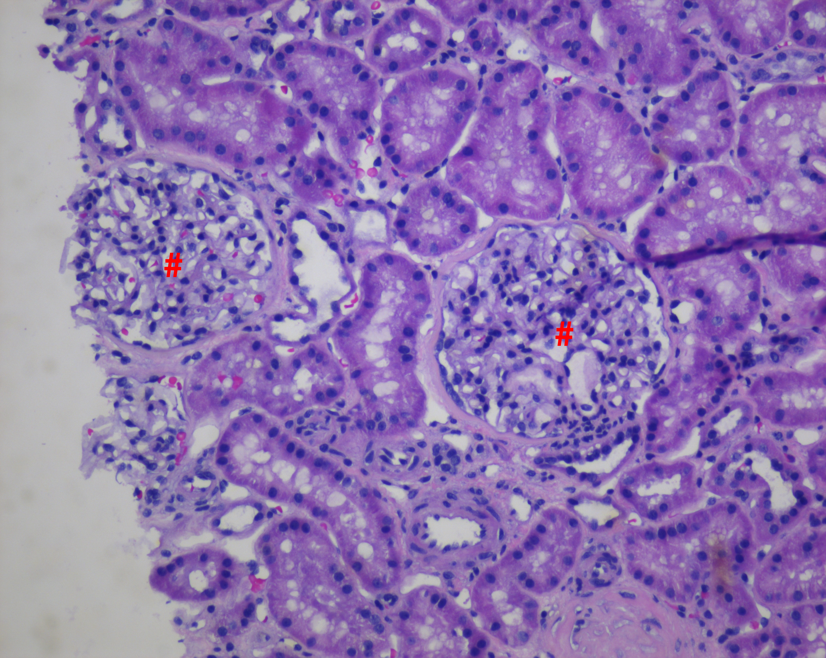 <p>Light Microscopy of Renal Parenchyma in Thin Basement Membrane Nephropathy